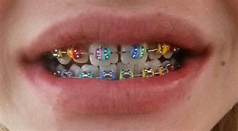 Bⓡⓐⓒⓔⓢ ⓒⓞⓛⓞⓡⓢ Braces Colors Orthodontics Braces Teeth Braces