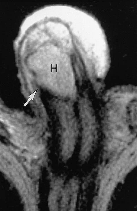 mr imaging of acute penile fracture radiographics