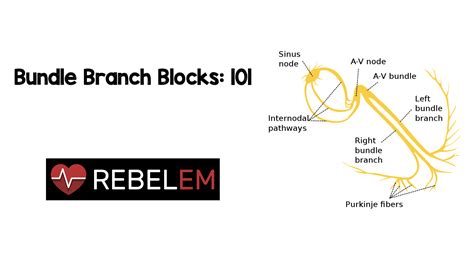 bundle branch blocks  rebel em emergency medicine blog
