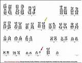 Q34 Q11 Bcr Karyotype Banded Abl1 Lymphoma Lymphoblastic Leukaemia sketch template