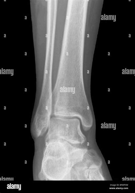 normal ankle joint  ray stock photo alamy