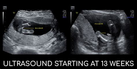 Early Gender Ultrasound Pricing Inside View 3d 4d Ultrasound