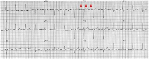 atrial flutter common and main atypical forms