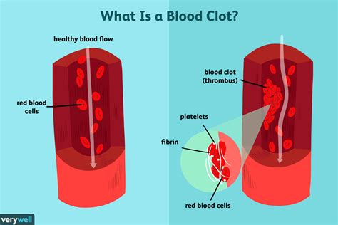 blood clot symptoms treatment prevention