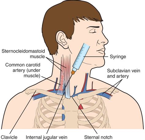 internal jugular veincentral venous access anesthesia key