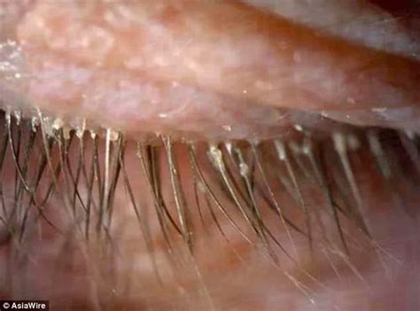 womans itchy eyes caused  mites  eyelashes  china daily mail
