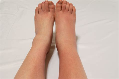 prolonged swelling   legs doctors  visit