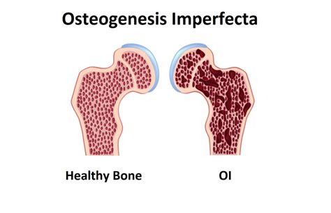 Types Of Osteogenesis Imperfecta Oi Brittle Bone Dise