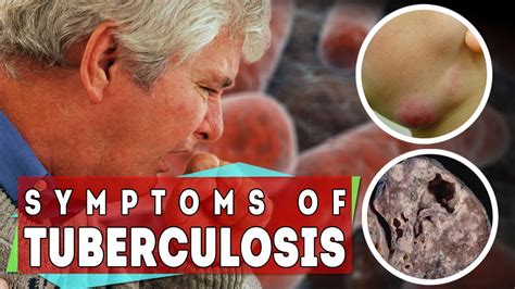tuberculosis symptoms  tb   types  stages youtube