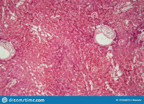 Liver Tissue With Amyloidosis Under A Microscope Stock Image Image Of