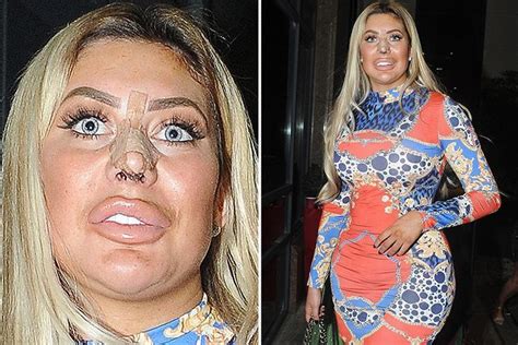 Chloe Ferry Hits The Town With Bandages On Her Face Just Four Days