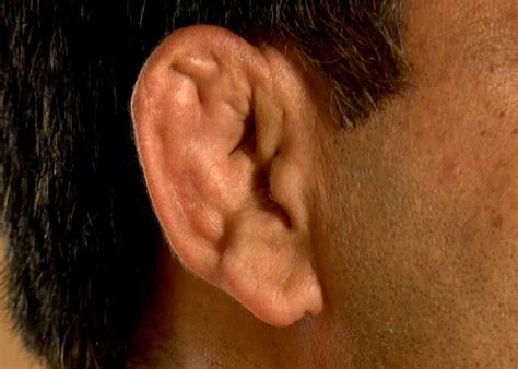 Have You Ever Wondered Why Wrestlers Have Disfigured Ears