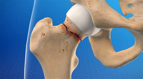 hip fracture