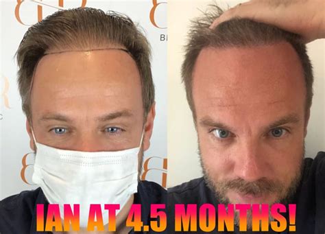 super fast growth  fue surgery bhr clinic hair transplant