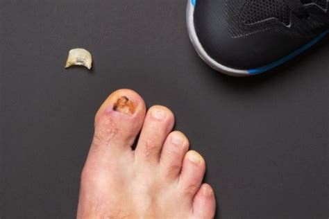 What To Do If Your Toenail Falls Off Core Plastic Surgery