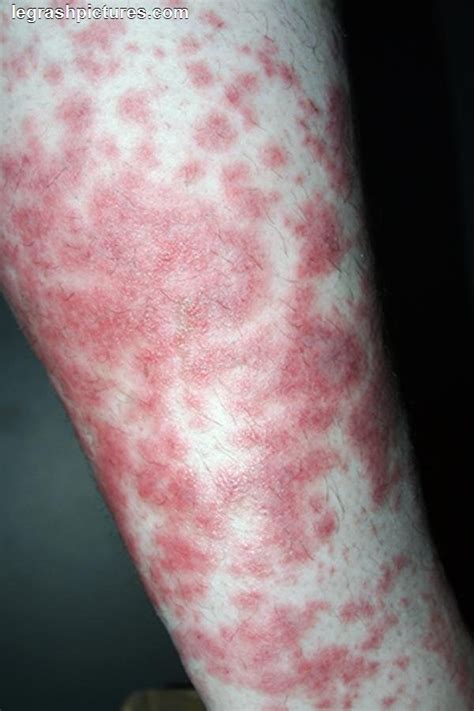 leg skin rash pictures