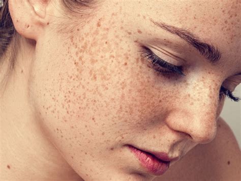 freckles to love or hate them beauty health times