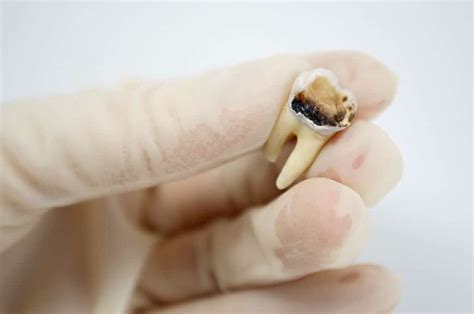 dead tooth symptoms  treatments
