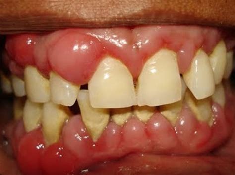 swollen gums symptoms  treatment pictures hubpages