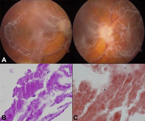 ocular amyloidosis ophthalmology
