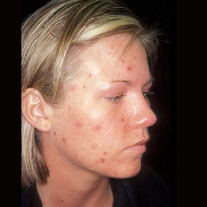 treatment  acne