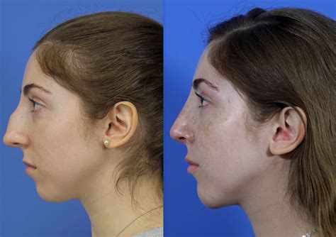 rhinoplasty nose job    savannah facial plastic surgery
