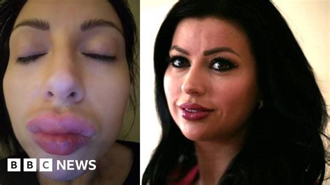 Lip Fillers Perfect Storm Due To Lack Of Regulation Bbc News