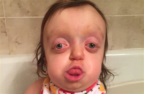 Girl Born With Severely Deformed Head Smiles Despite Strangers