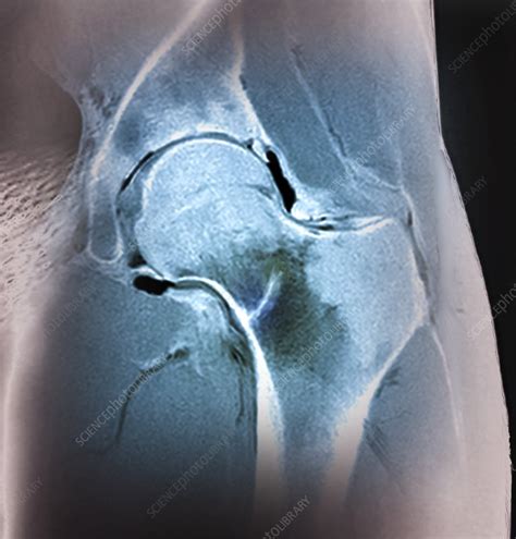 hip stress fracture mri scan stock image  science photo