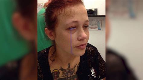 This Ottawa Woman Got An Eyeball Tattoo And Now She Could Lose Her Eye