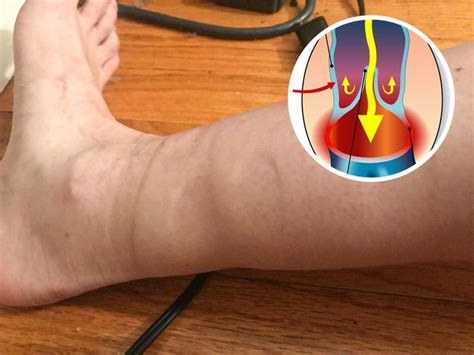 4 Health Issues That Sock Marks May Signal Swollen Legs Swollen Feet