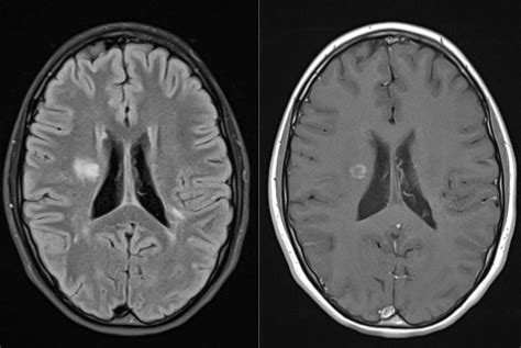 Active Ms Plaques On Dwi B1000 Radiology Imaging