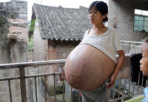 Chinese Woman Has A Very Large Belly Due To An Unknown Disease Ordo News