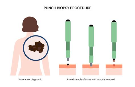 punch biopsy purpose preparation risks  results