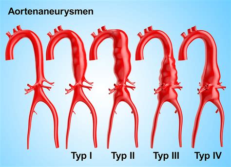 aneurysma aorta ascendens aortenaneurysma bis wann sport ab wann op