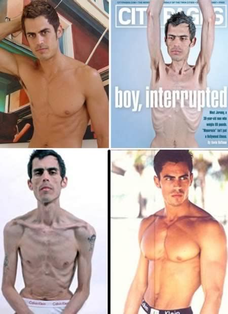 Anorexia The Male Model