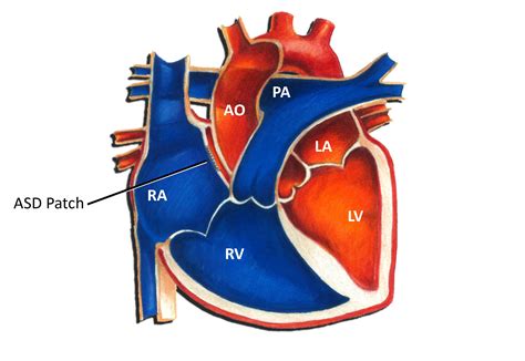 atrial septal defect pediatric heart specialists