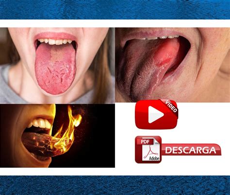 ardor en la boca sindrome de la boca ardiente clinica diagnostico tratamiento  caso
