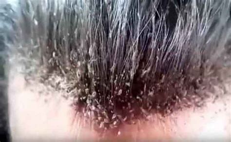 hair dye kill lice   eggs caraway seeds health benefits