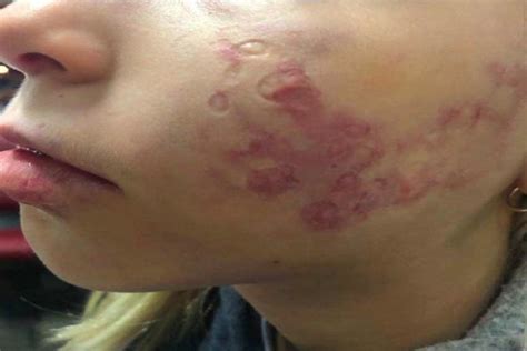 Doctor Scarred Girl S Face During Laser Treatment To Remove Birthmark Suit