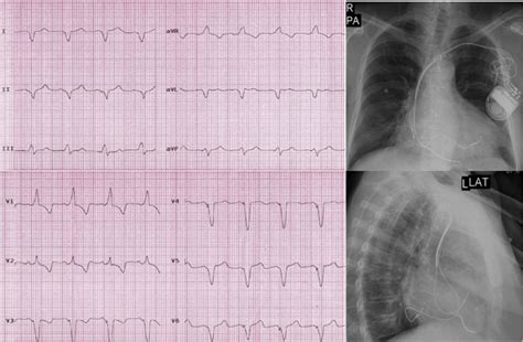 Twelve Lead Ecg And Chest X Ray Pa And Lateral Views Of