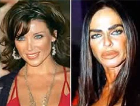 17 celebrity before and after plastic surgery disasters