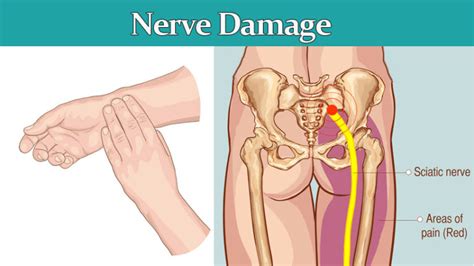 symptoms  nerve damage     womenworking