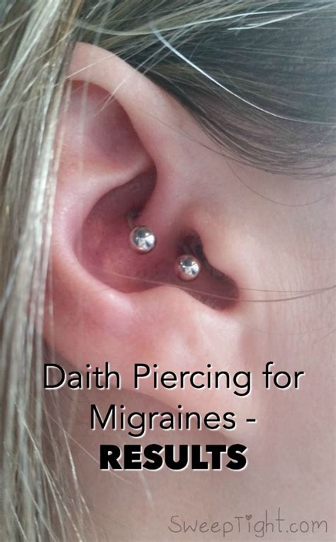 one month of results after ear piercing for migraines