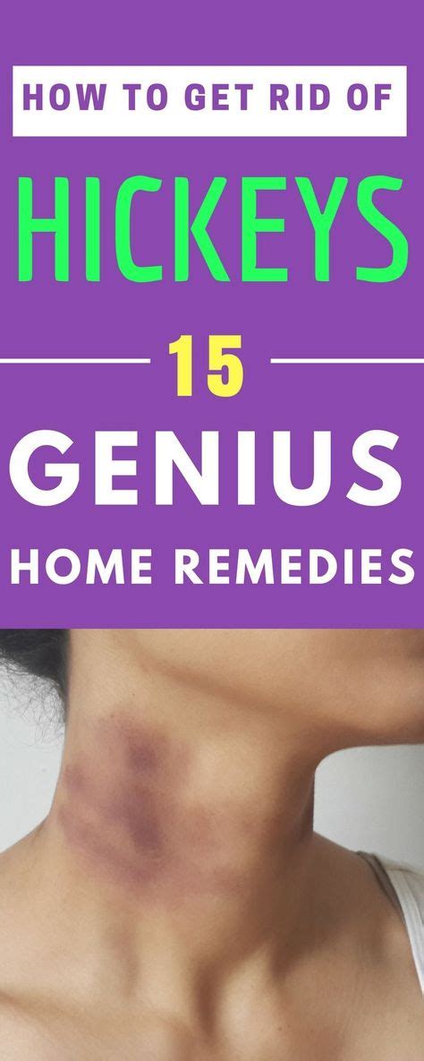 15 home remedies how to get rid of a hickey fast and overnight how