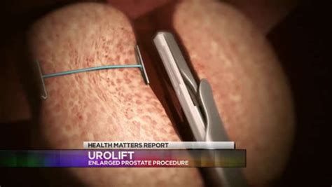 Urolift Procedure One News Page Video
