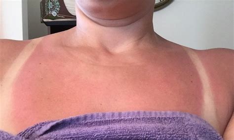 Trust Us Youll Want To Save This Moms Viral Sunburn Tip Sunburn