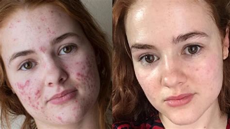 woman documented  acne transformation      accutane