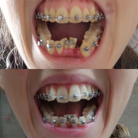 weeks  braces    extraction yesterday