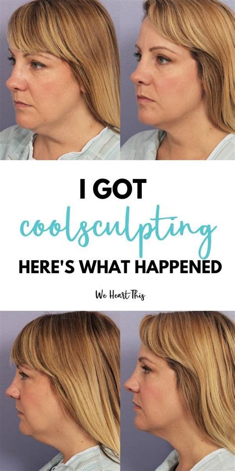 coolsculpting  work  chin home  garden reference